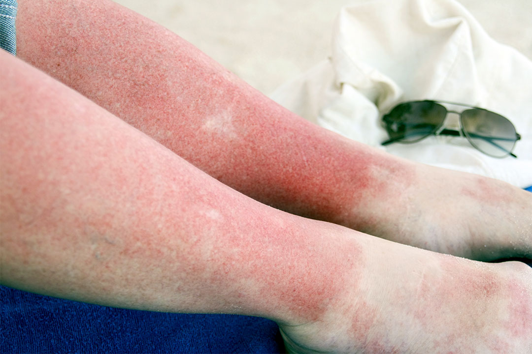 Download Too Much Sun? What You Should Know about Sun Poisoning ...